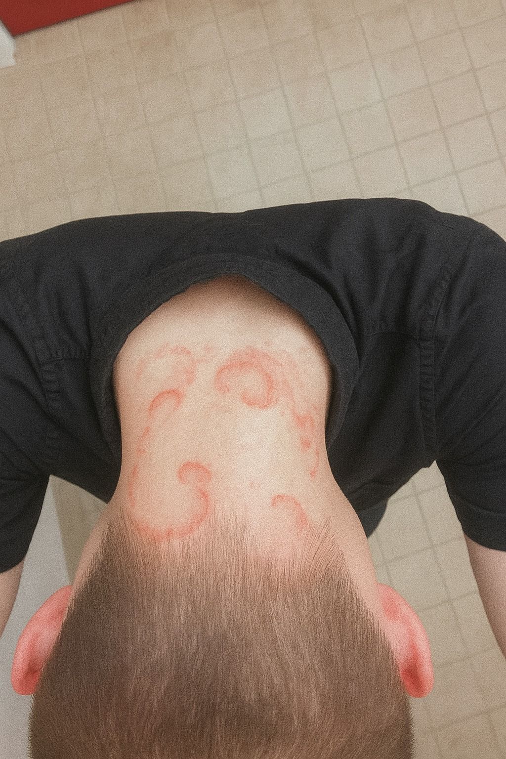 Oğlumun Kafasında ve Ensesinde Kızarıklar Gördüm